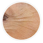 Chemical Peel