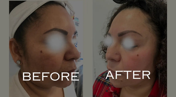 Cosmelan Before and after treatment